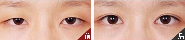 上睑下垂适合做哪种双眼皮