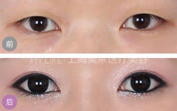 埋线双眼皮手术会开线吗