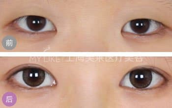 割双眼皮和开眼角多少钱