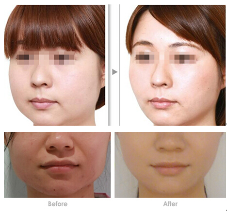 面部吸脂真的能瘦脸吗