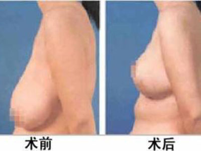 女人孕期预防乳房下垂方法