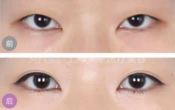 上睑下垂矫正可以改善视力吗