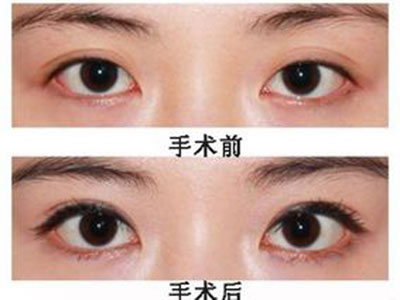 上海如何修复失败的双眼皮呢