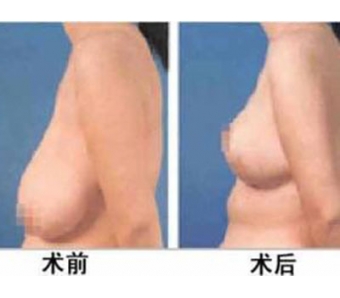女人孕期预防乳房下垂方法