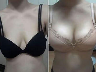 韩式假体隆胸手术有什么特点