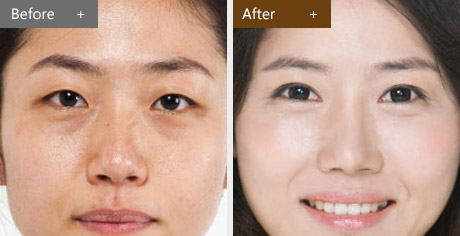 祛眼袋要了解哪些情况