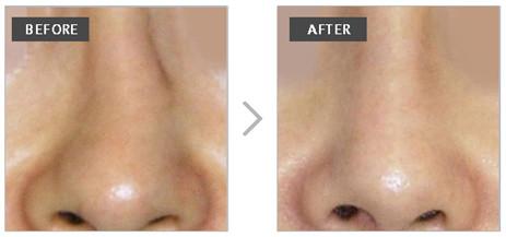 歪鼻整形术有哪些适应症