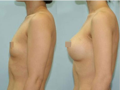 自体脂肪移植手术是可以信任的吗