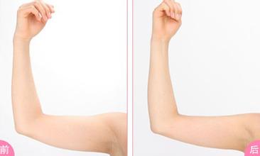 有哪些人是不适合做手臂吸脂减肥手术