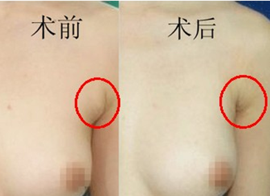 女人怎么会有副乳?