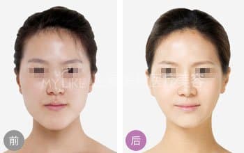 注射瘦脸注意什么