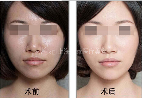 注射美肤针术后白的自然吗