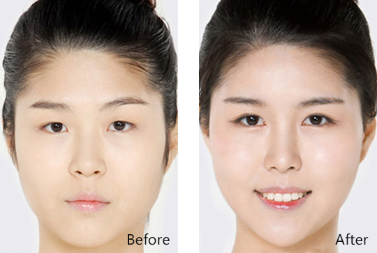 用开眼角眼部整形后如何护理呢