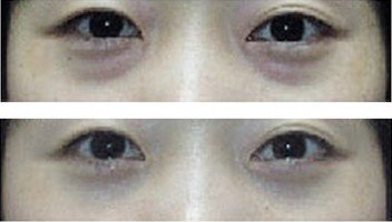 光子嫩肤可以去黑眼圈吗