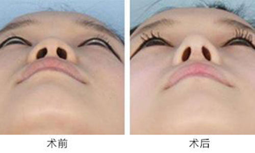 上海鼻翼缩小术安全吗