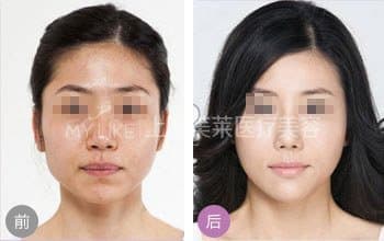 上海激光美白嫩肤多少钱