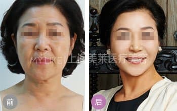 水光针注射除皱可以维持多久