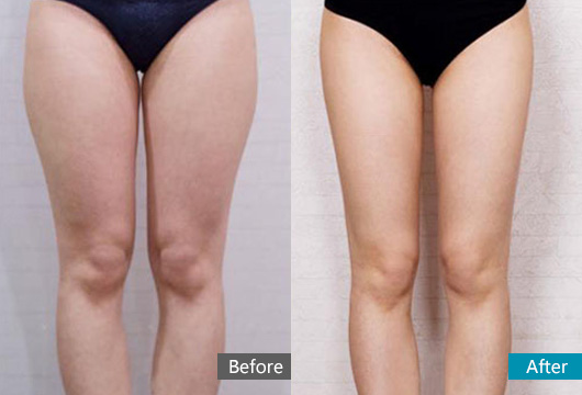 上海注射瘦小腿怎么样