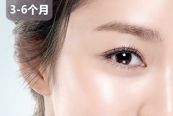 上海美莱双眼皮修复