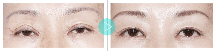 上海美莱双眼皮修复