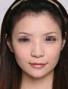 上海美莱综合隆鼻