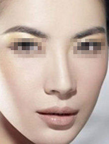 上海美莱综合隆鼻