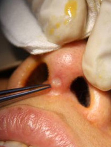 上海美莱综合隆鼻