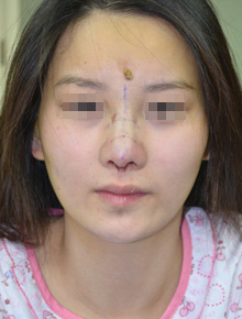 上海美莱综合隆鼻