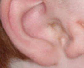下耳郭畸形