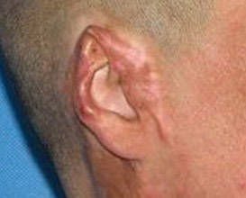 后天性小耳畸形
