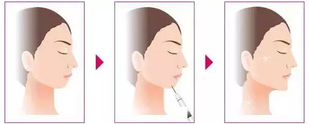 注射丰下巴