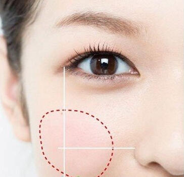 上海有效去晒斑的方法是什么