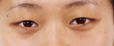 上睑下垂