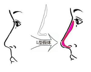 假体隆鼻的可以维持时间