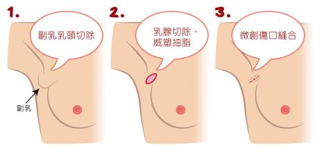 副乳切除