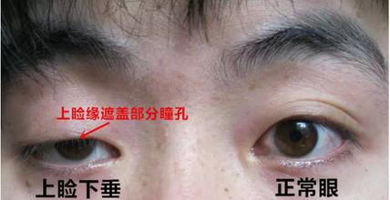 上睑下垂