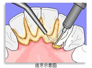 上海超声波洁牙会不会损伤牙龈