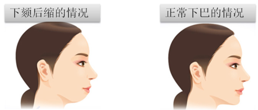 假体丰下巴
