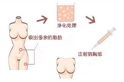 美莱自体脂肪丰胸