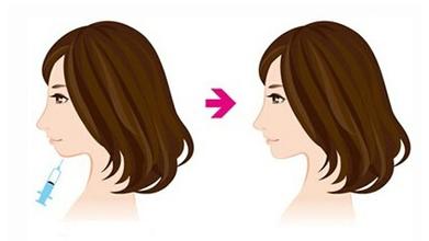 美莱注射丰下巴