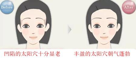 自体脂肪丰太阳穴