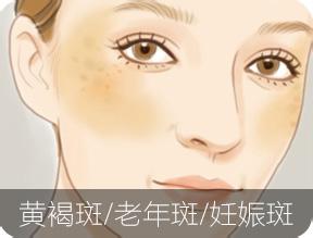 祛斑