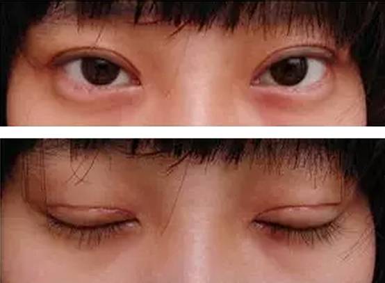 双眼皮