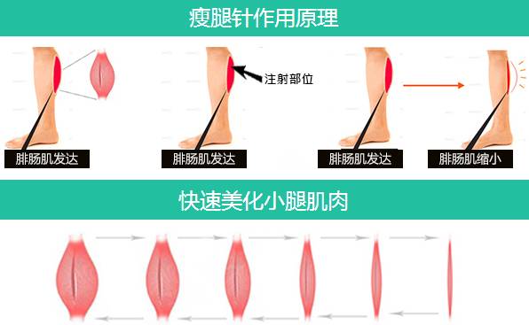注射瘦腿