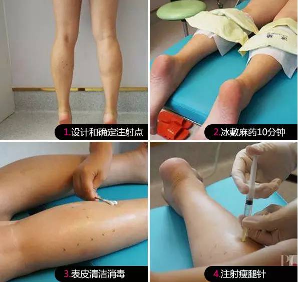 注射瘦腿