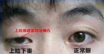 上睑下垂