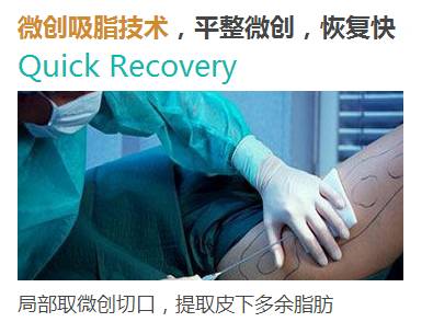 自体脂肪丰胸