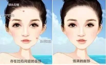 自体脂肪抗衰老