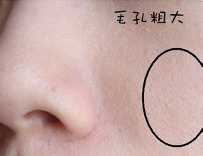 毛孔粗大