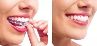 美莱隐形牙齿矫正